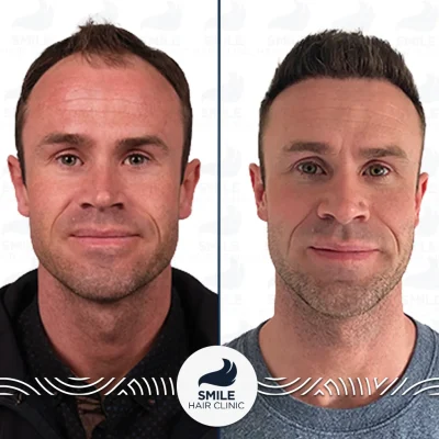 Kasper L 4500 Grafts Sapphire FUE Before After(3)_2026
