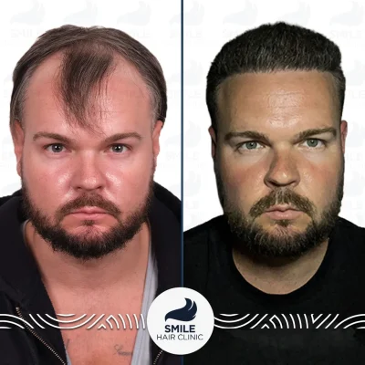 Kyle B 4250 Grafts Sapphire FUE Before After_2026