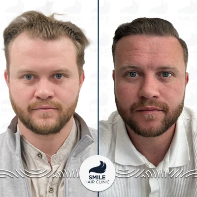 Lukas M 2800 Grafts Sapphire FUE Before After(2)_2026