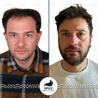 Paolo F 4800 Grafts Sapphire FUE Before After(4)_2026