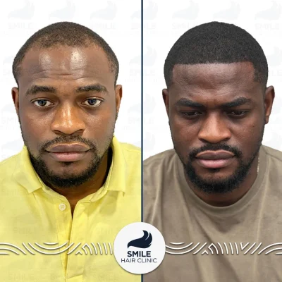 Seteven M 2800 Grafts Sapphire FUE Before After(2)_2026