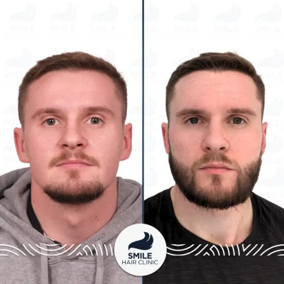 Thomas M 4100 Grafts Sapphire FUE Beard Transplant Before After(1)_2026