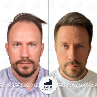 ViktorN5000GraftsSapphireFUEHairTransplant_2026