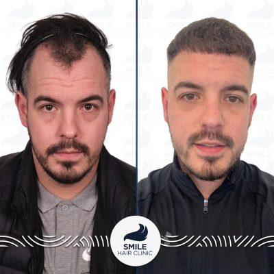 3250 Grafts Sapphire FUE Hair Transplant Turkey Before After