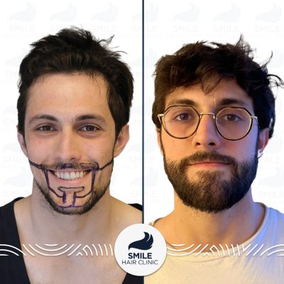 3700 Grafts Sapphire FUE Beard Transplant Turkey Before After