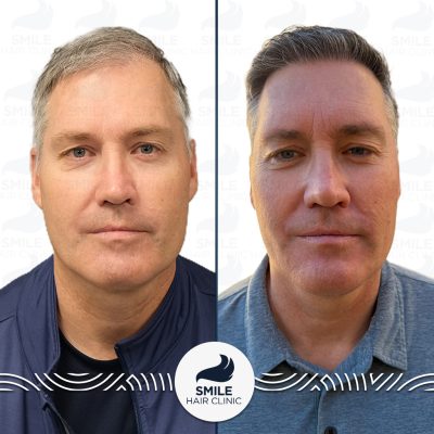 4100 Grafts Sapphire FUE Hair Transplant Before After