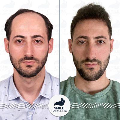 4250 Grafts Sapphire FUE Hair Transplant Turkey Before After