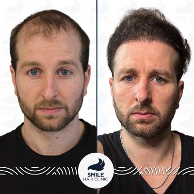 4700 Grafts Sapphire FUE Hair Transplant Before After