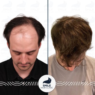 4750 Grafts Sapphire FUE Hair Transplant Turkey Before After