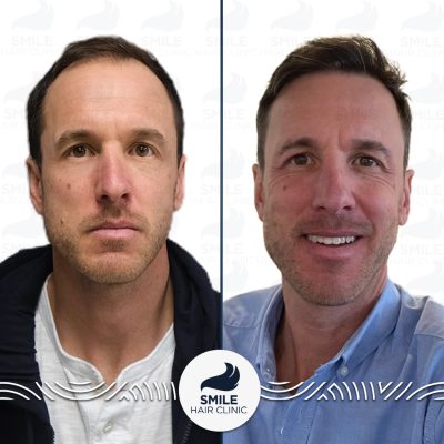 5000 Grafts Sapphire FUE Hair Transplant Turkey Before After(1)