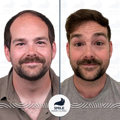 5000 Grafts Sapphire FUE Hair Transplant Turkey Before After(2)