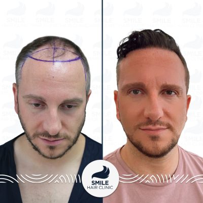 5050 Grafts Sapphire FUE Hair Transplant Turkey Before After