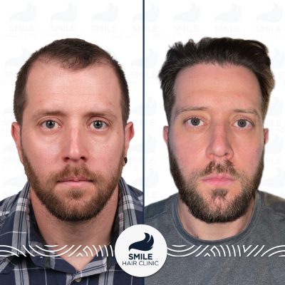 5100 Grafts Sapphire FUE Hair Transplant Turkey Before After