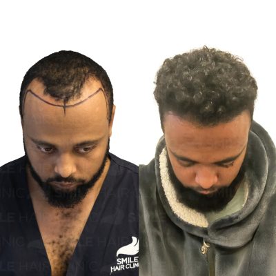 Afro hair transplant in turkey before after - 2500 Grafts