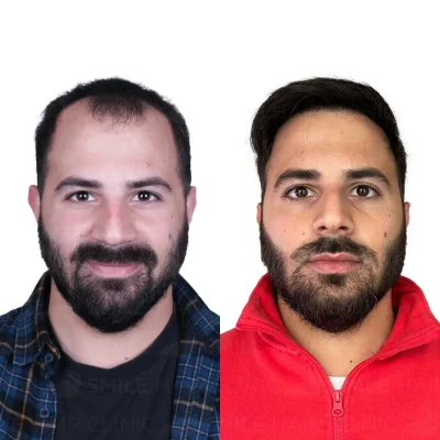 Hair transplant in turkey before after - 4000 Grafts - Sapphire FUE (3)_2026
