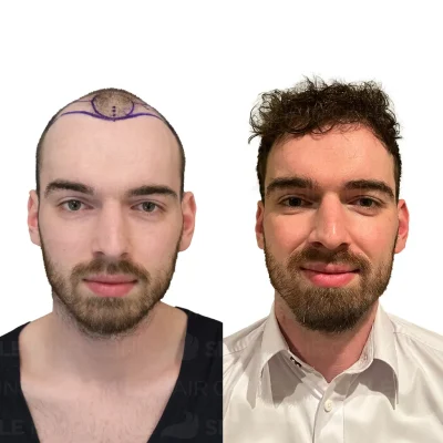 Hair transplant in turkey before after - 4000 Grafts - Sapphire FUE (4)_2026