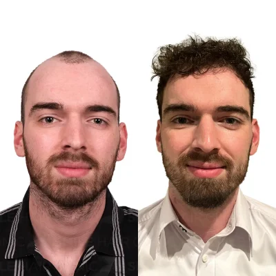 Hair transplant in turkey before after - 4000 Grafts - Sapphire FUE (5)_2026