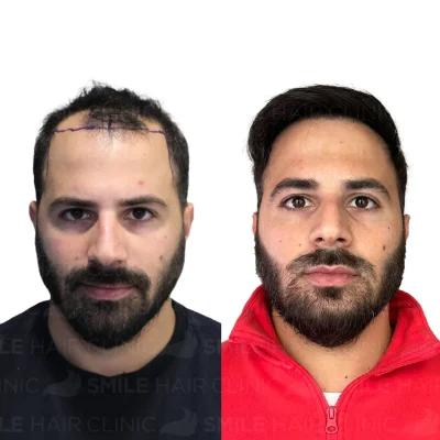 Hair transplant in turkey before after - 4000 Grafts - Sapphire FUE (6)_2026