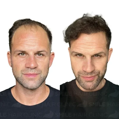 Hair transplant in turkey before after - 4100 Grafts_2026