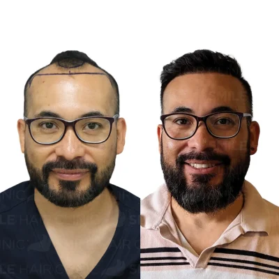 Hair transplant in turkey before after - 4500 Grafts - Sapphire FUE (3)_2026