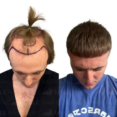 Hair transplant in turkey before after - 4700 Grafts Sapphire FUE_2026