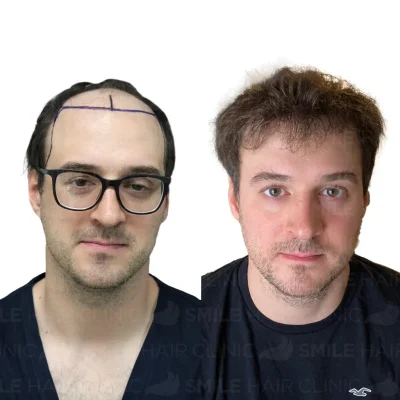 Hair transplant in turkey before after - 4750 Grafts Sapphire FUE (2)_2026