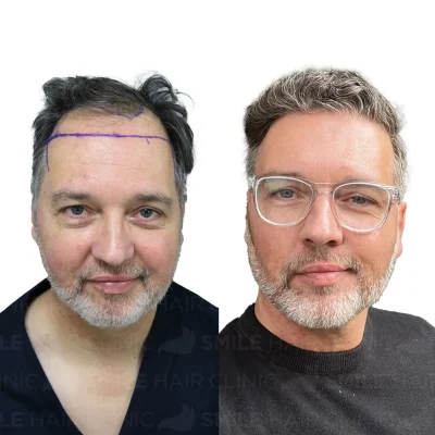 Hair transplant in turkey before after - 4750 Grafts_2026
