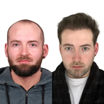 Hair transplant in turkey before after - 4900 Grafts - Sapphire FUE_2026