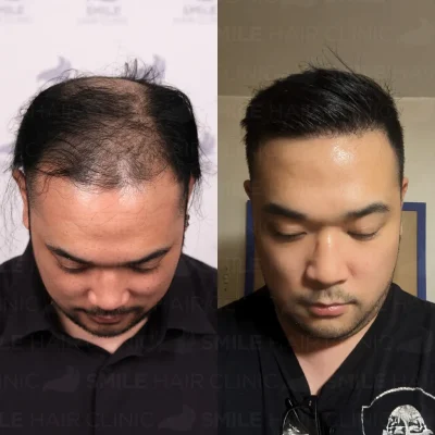 Hair transplant in turkey before after - 5000 Grafts Sapphire FUE_2026
