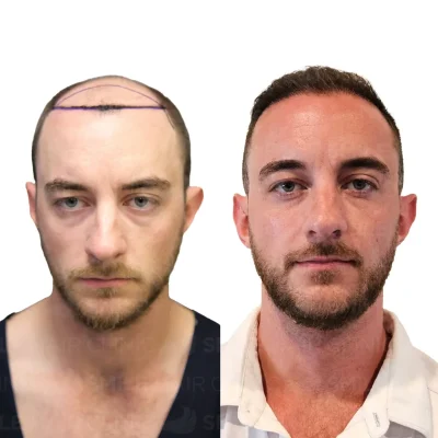 Hair transplant in turkey before after - 5000 Grafts - sapphire fue_2026