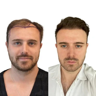 Hair transplant in turkey before after - 5400 Grafts - Sapphire FUE_2026