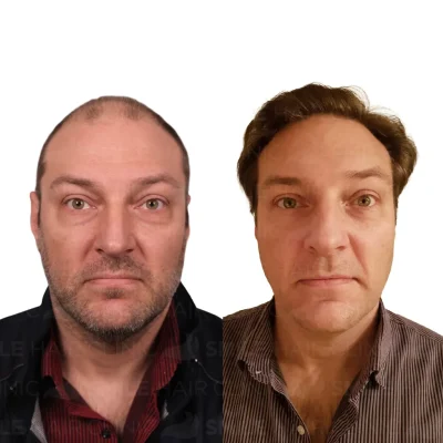 Hair transplant in turkey before after - 5500 Grafts_2026