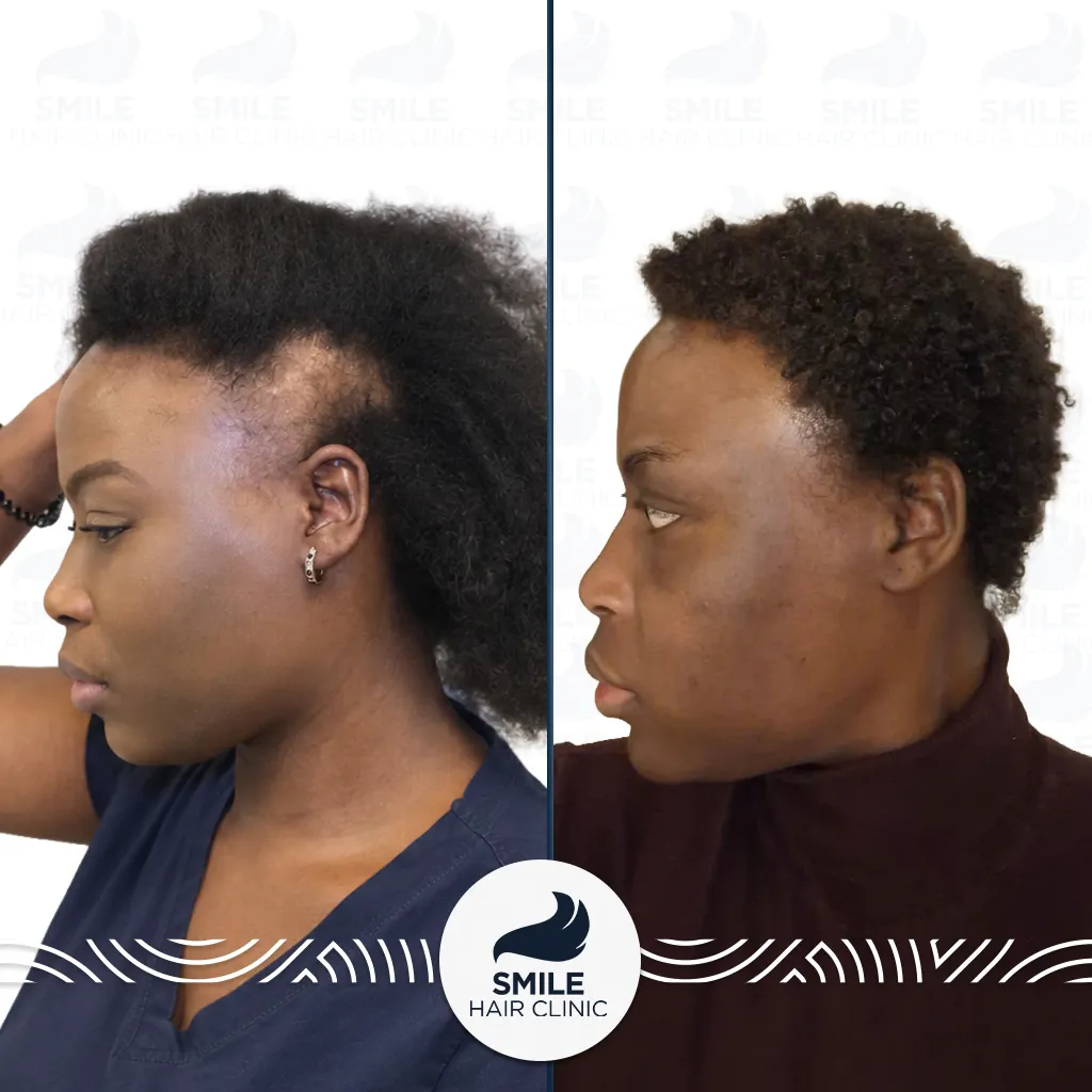 1700 Grafts Sapphire FUE Afro Female Hair Transplant Before After_2026