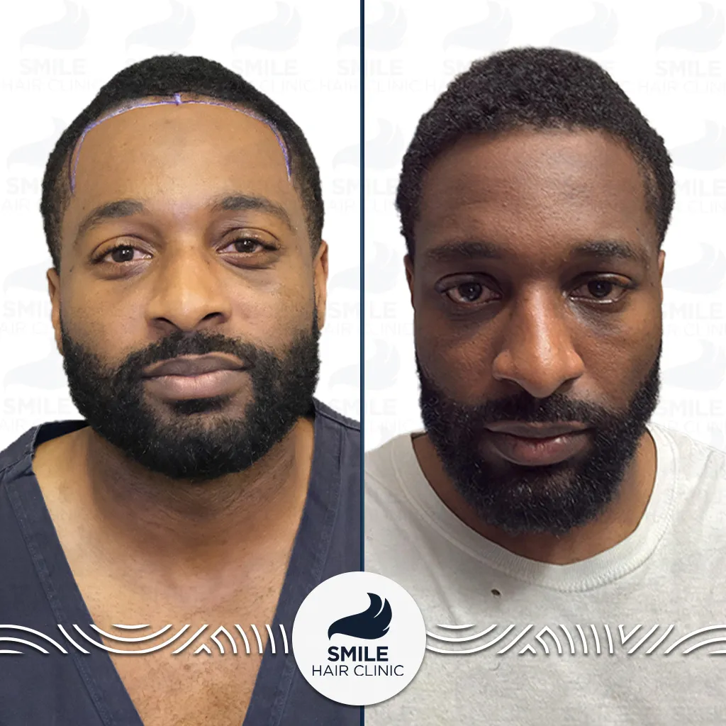 1850 Grafts Afro Hair Transplant Before After_2026