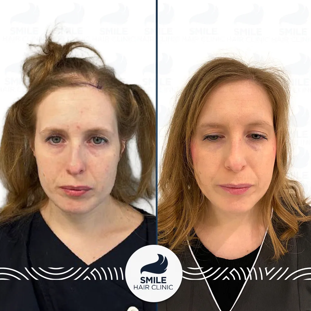 2150 Grafts DHI Female Hair Transplant Before After_2026