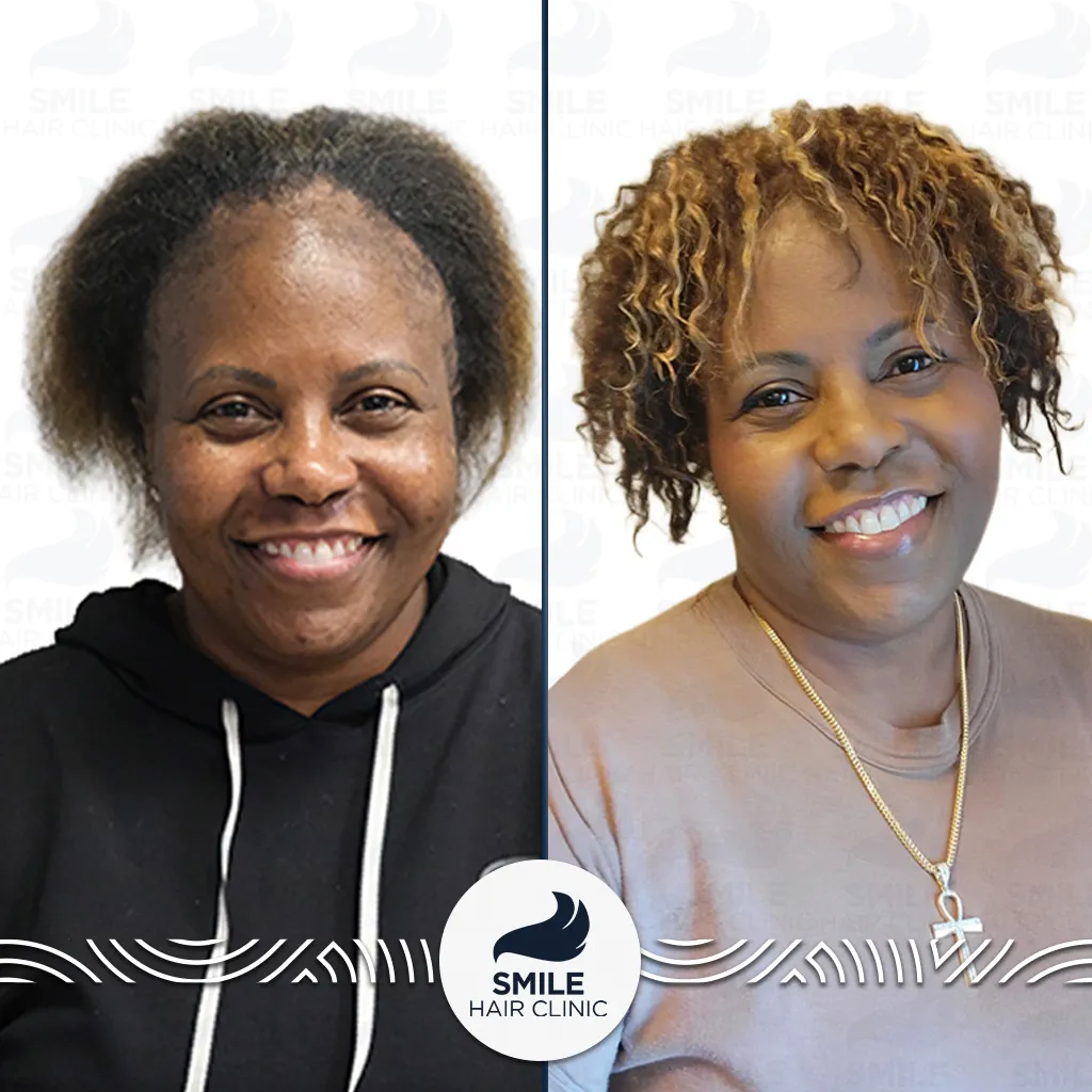 2400 Grafts Sapphire FUE Afro Hair Transplant Before After_2026