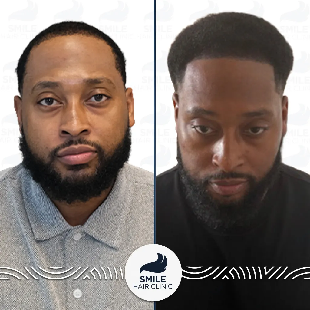 2500 Grafts Afro Hair Transplant Before After_2026