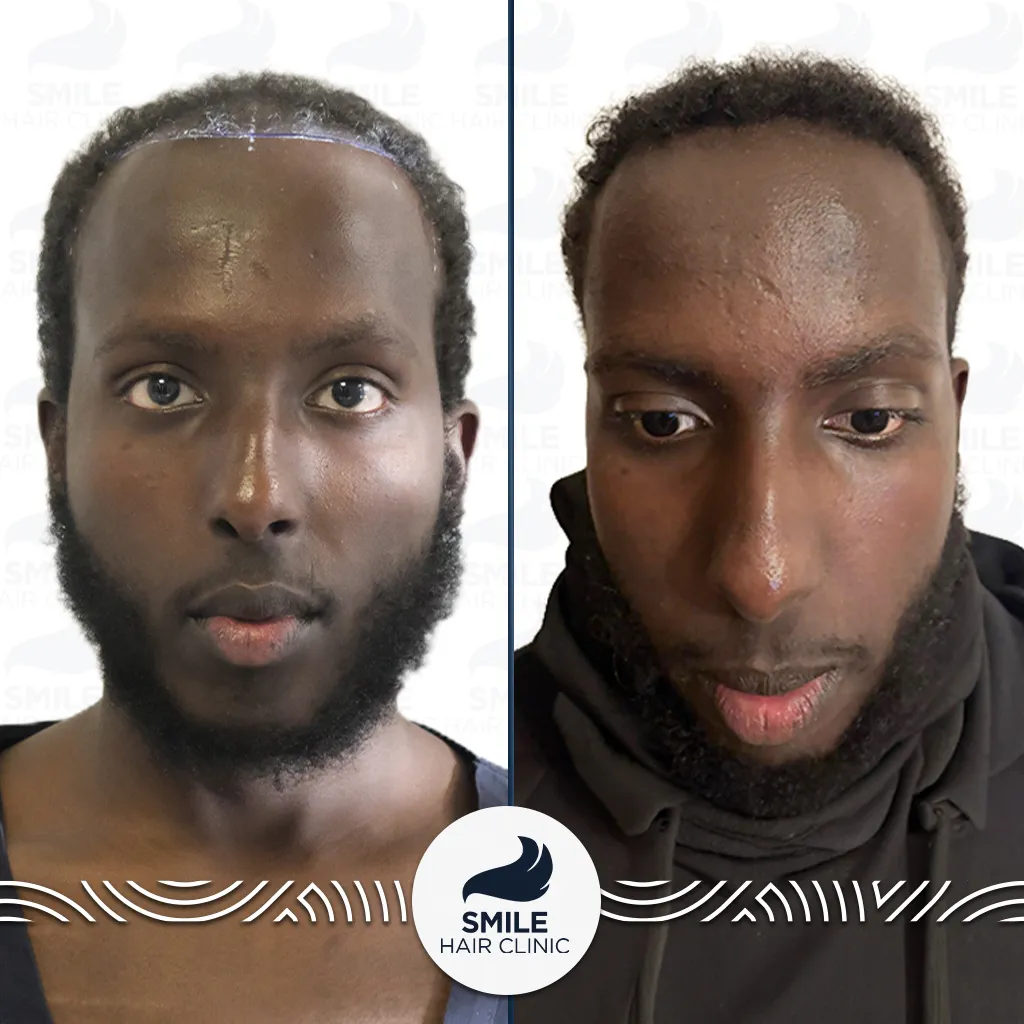 2600 Grafts Afro Hair Transplant Before After_2026