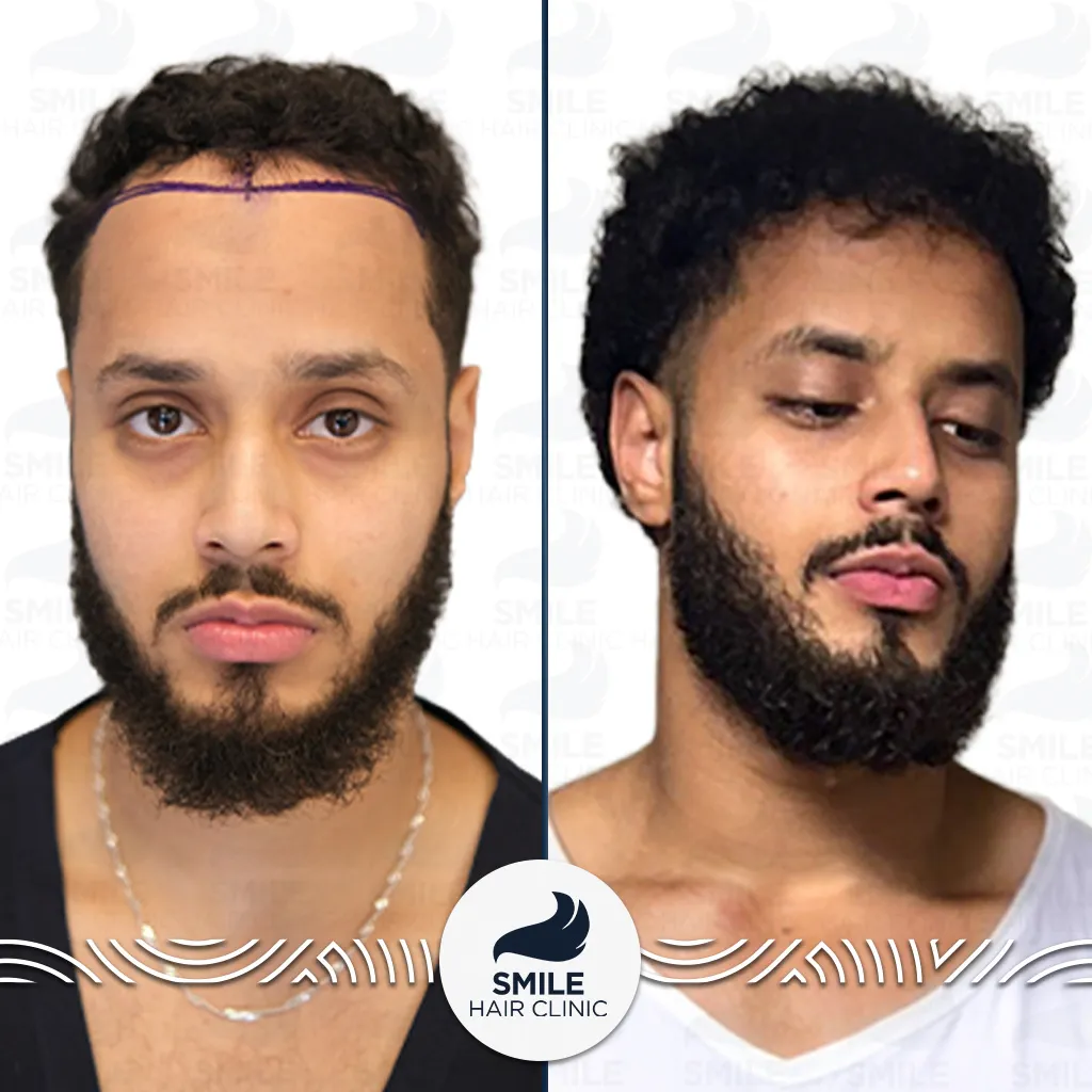 2800 Grafts Sapphire FUE Hair Transplant Before After_2026
