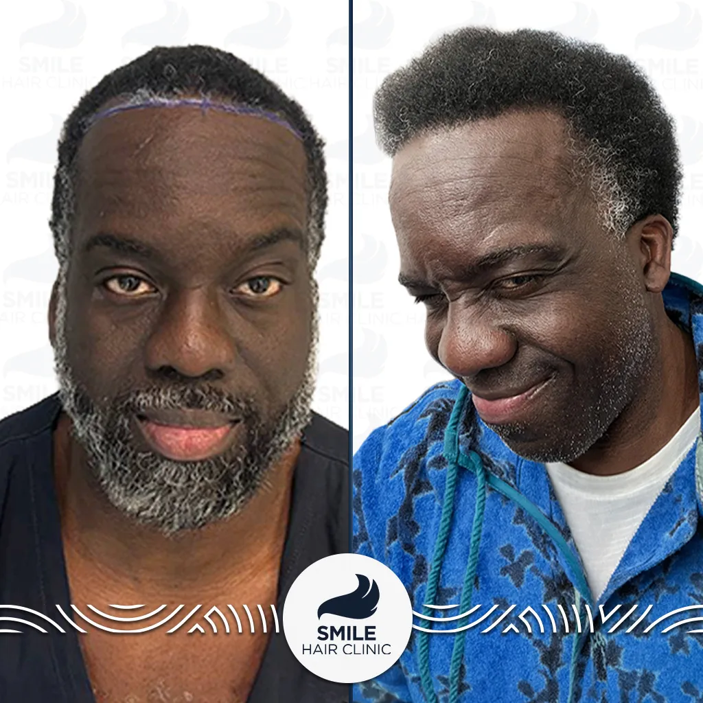 3050 Grafts Afro Hair Transplant Before After_2026