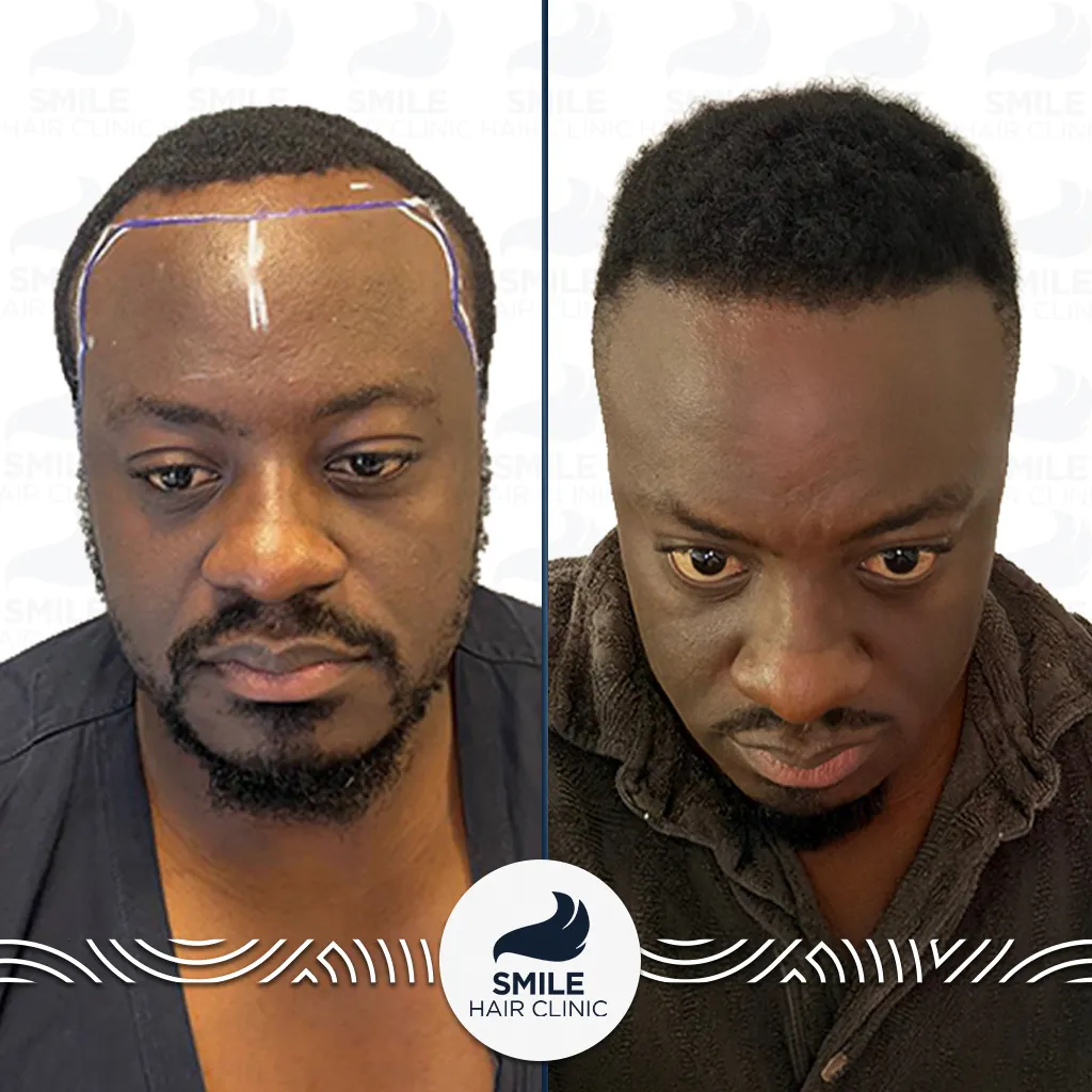 3100 Grafts Afro Hair Transplant Before After_2026