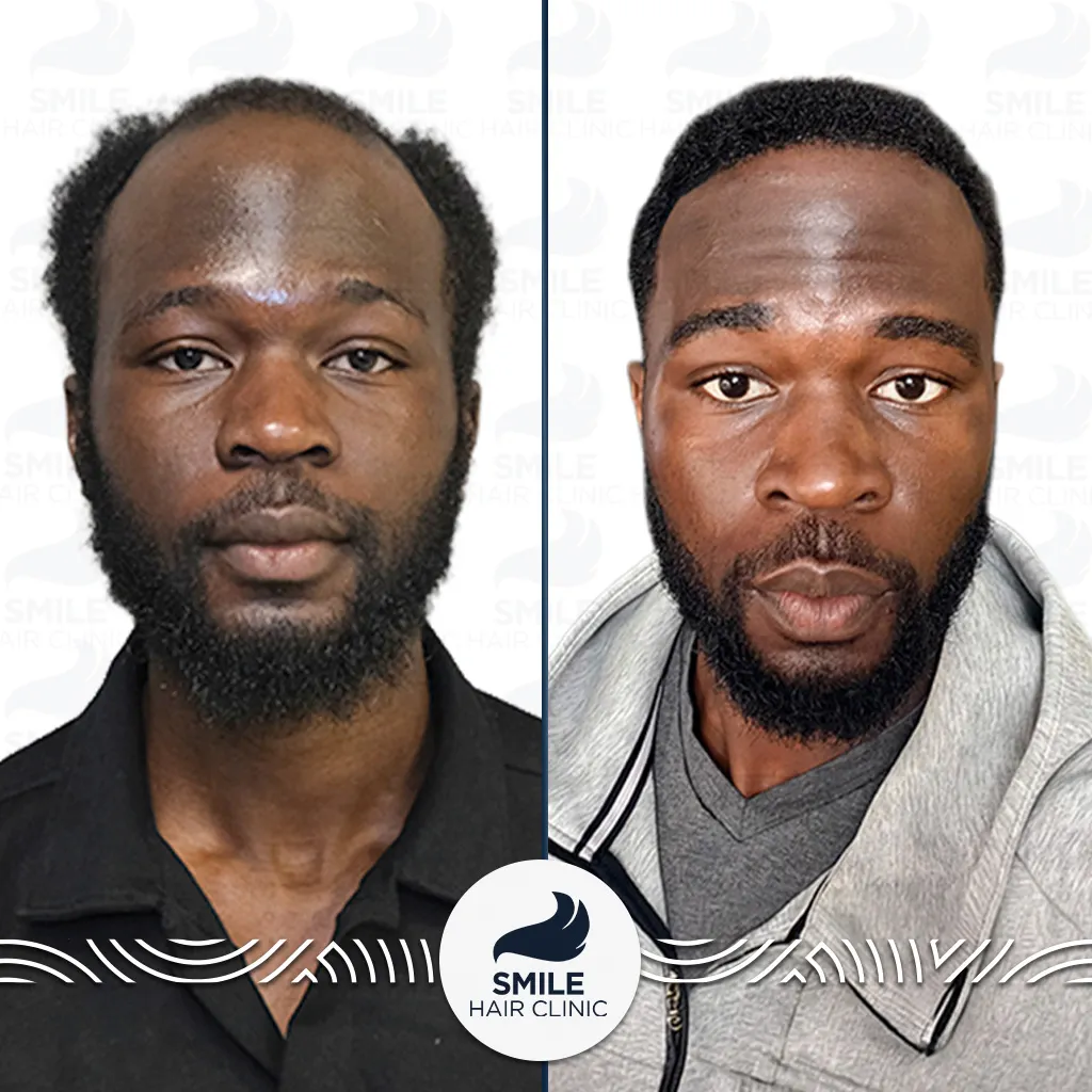 3150 Grafts Afro Hair Transplant Before After_2026
