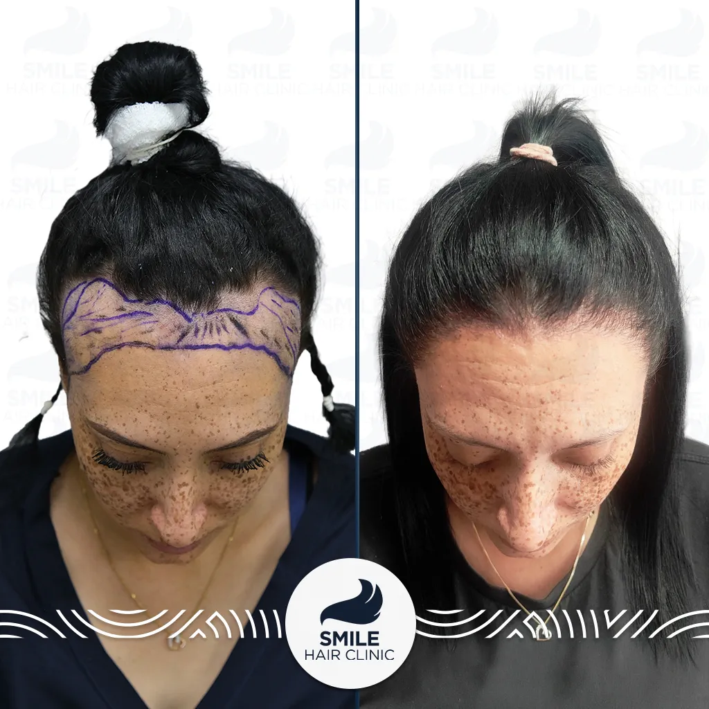 3200 Grafts Sapphire FUE Female Hair Transplant Before After_2026