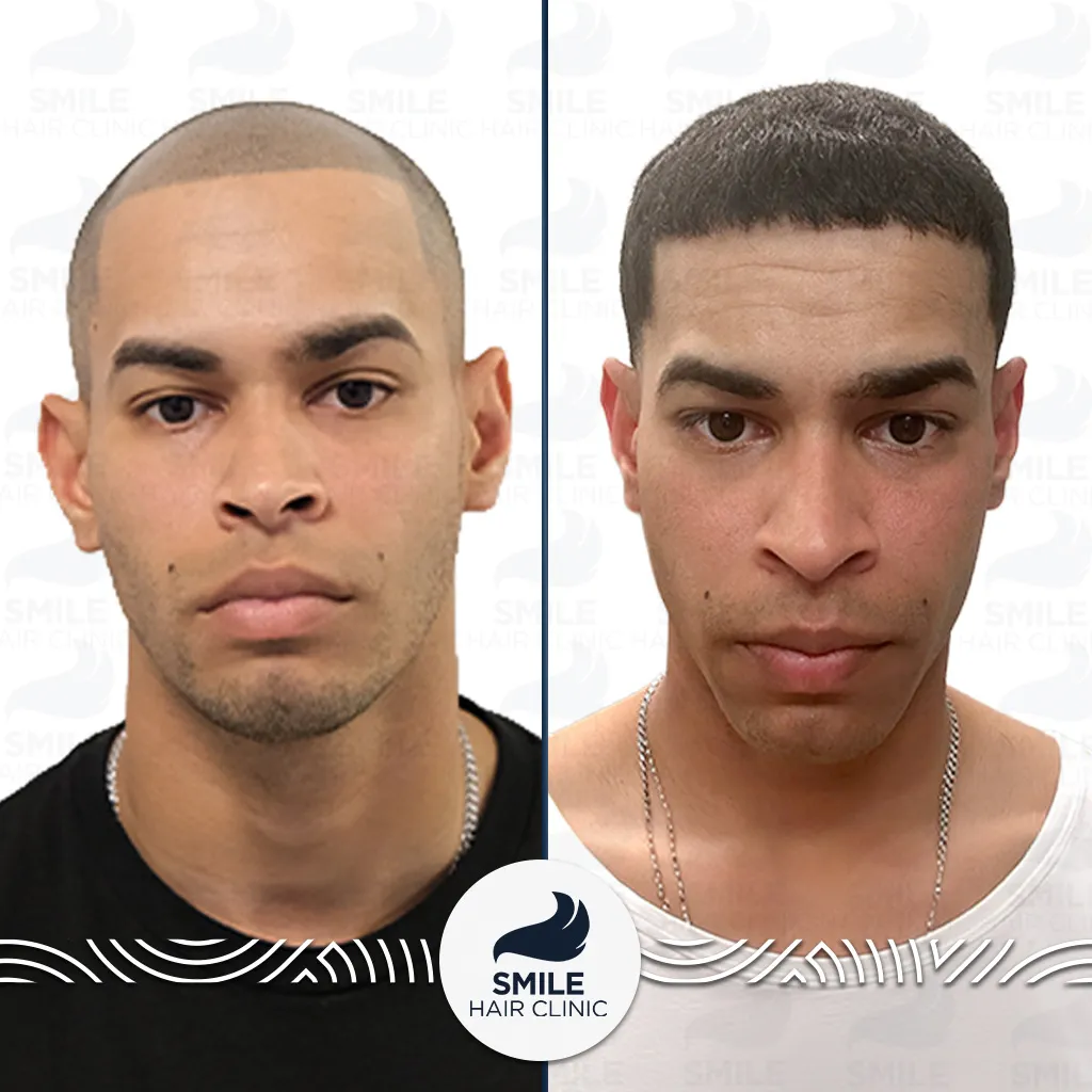 3700 Grafts Sapphire FUE Hair Transplant Before After_2026