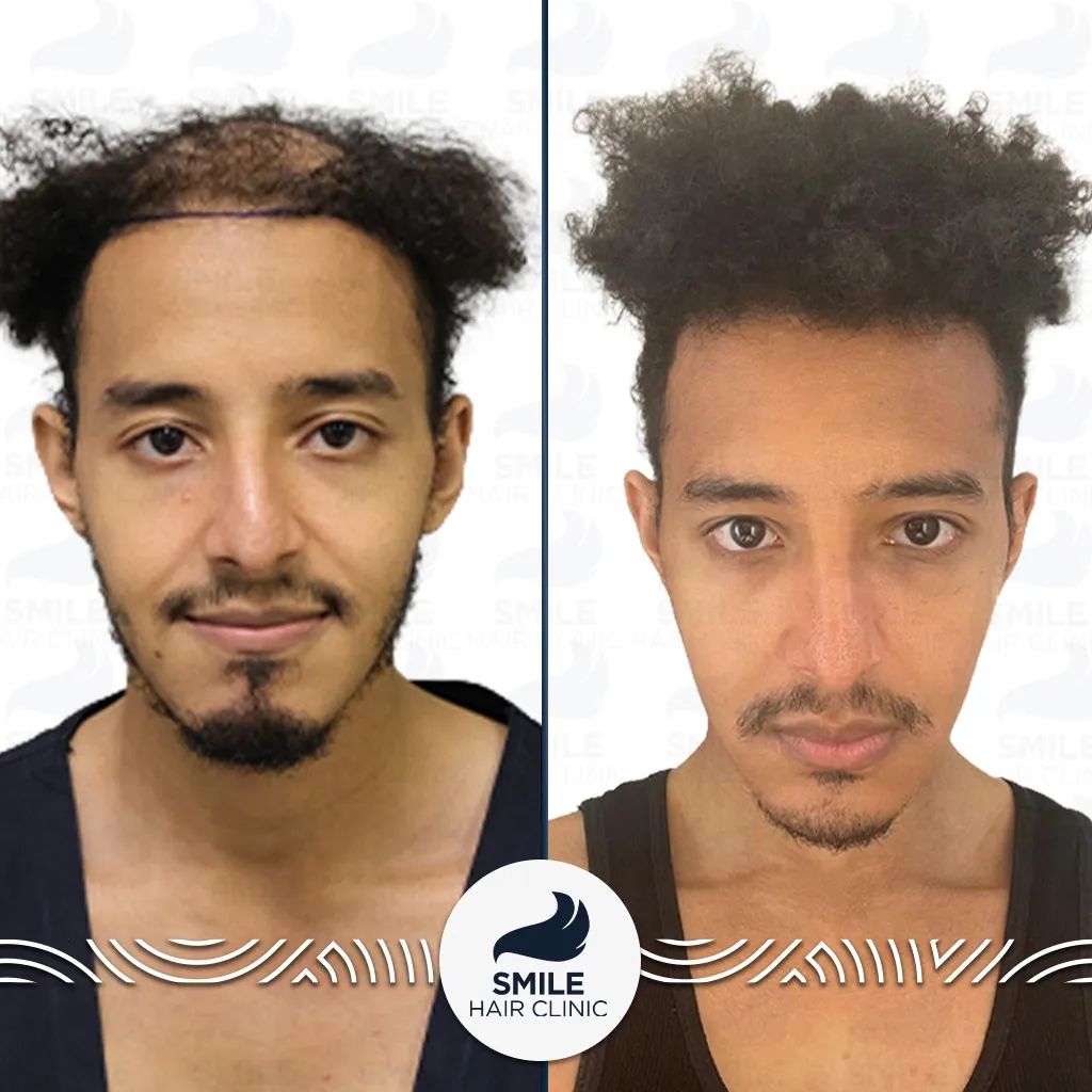 3800 Grafts Afro Hair Transplant Before After_2026
